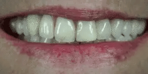 Easy Fit Smile Veneers for Top and Bottom Teeth
