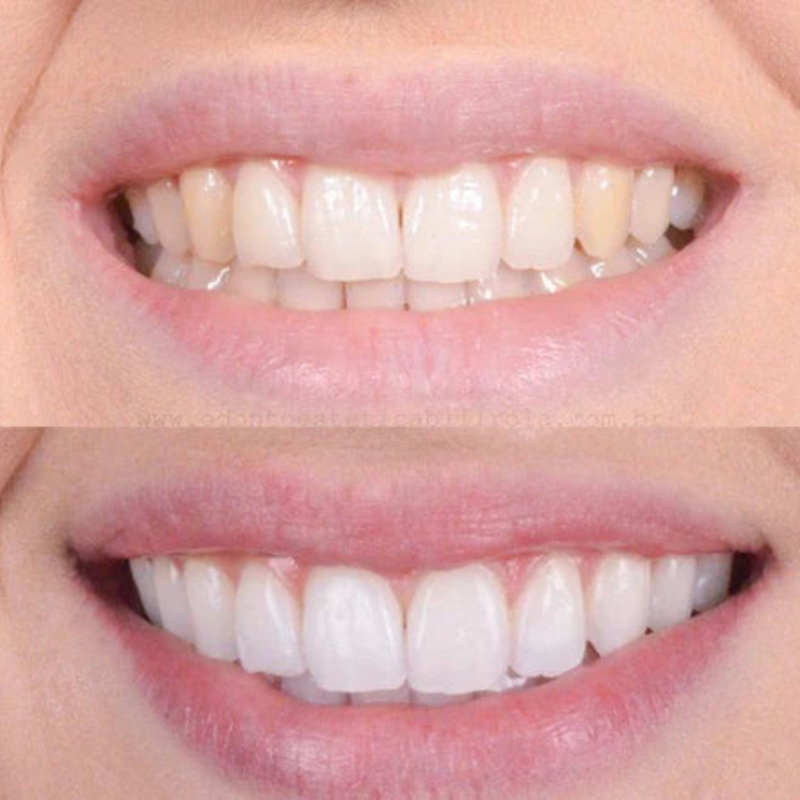 Fast At Home Teeth Whitening Kit
