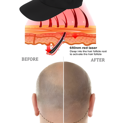 Advanced Hair Regrowth Laser Cap Device - Lusomart