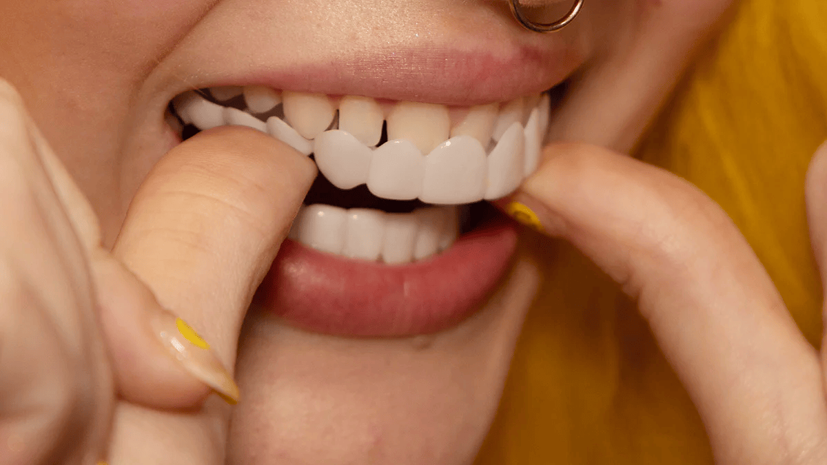 Easy Fit Clip On Veneers For A Perfect Smile