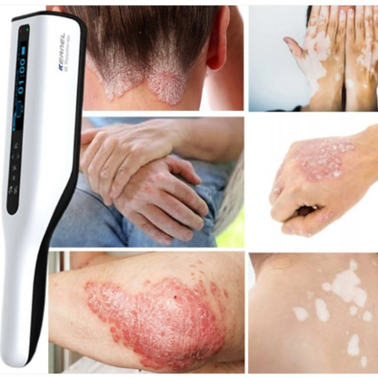 Compact UVB Light Therapy Lamp for Skin Treatment