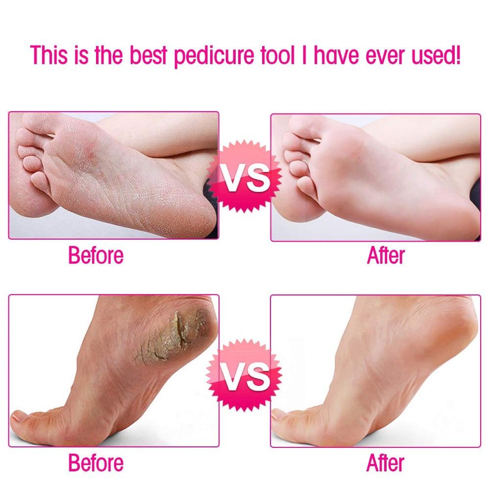 Easy To Use Foot And Hand Callus Shaver