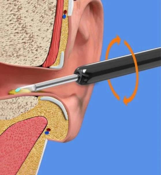 Advanced Wireless Ear Wax Remover