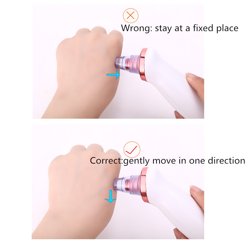 Effective Blackhead Remover Vacuum Cleaner