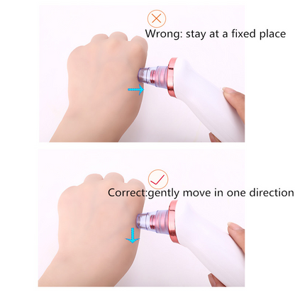 Effective Blackhead Remover Vacuum Cleaner