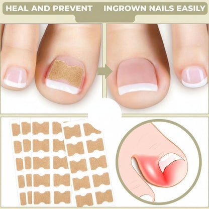 Fast Ingrown Toenail Relief Patches