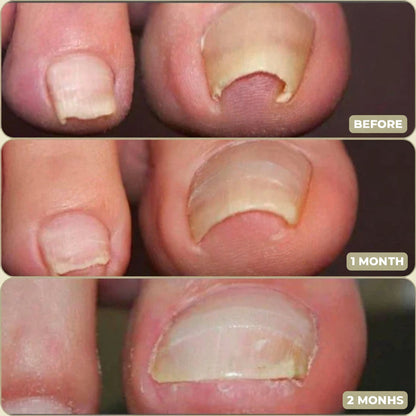Fast Ingrown Toenail Relief Patches