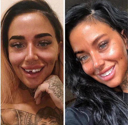 Easy Fit Smile Veneers for Top and Bottom Teeth