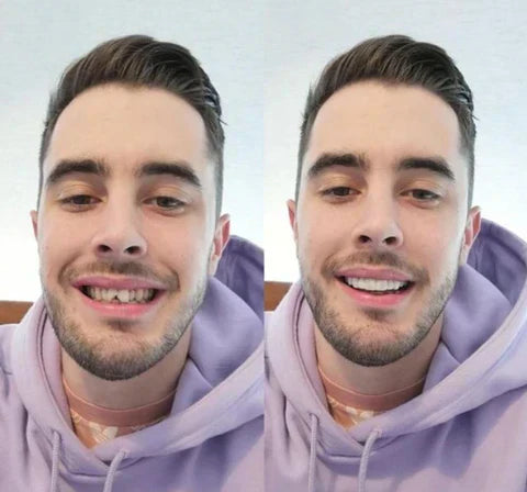 Easy Fit Clip On Veneers For A Perfect Smile