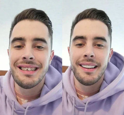 Easy Fit Clip On Veneers For A Perfect Smile