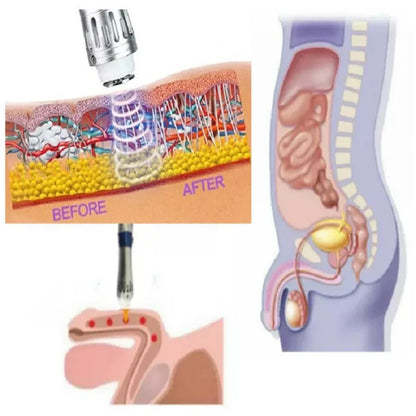 Compact Male Performance Wave Therapy Device