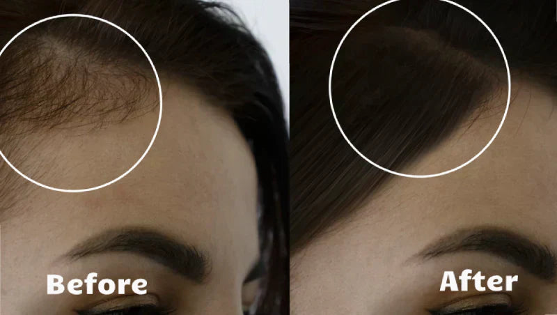 Advanced Hair Growth Therapy Laser System