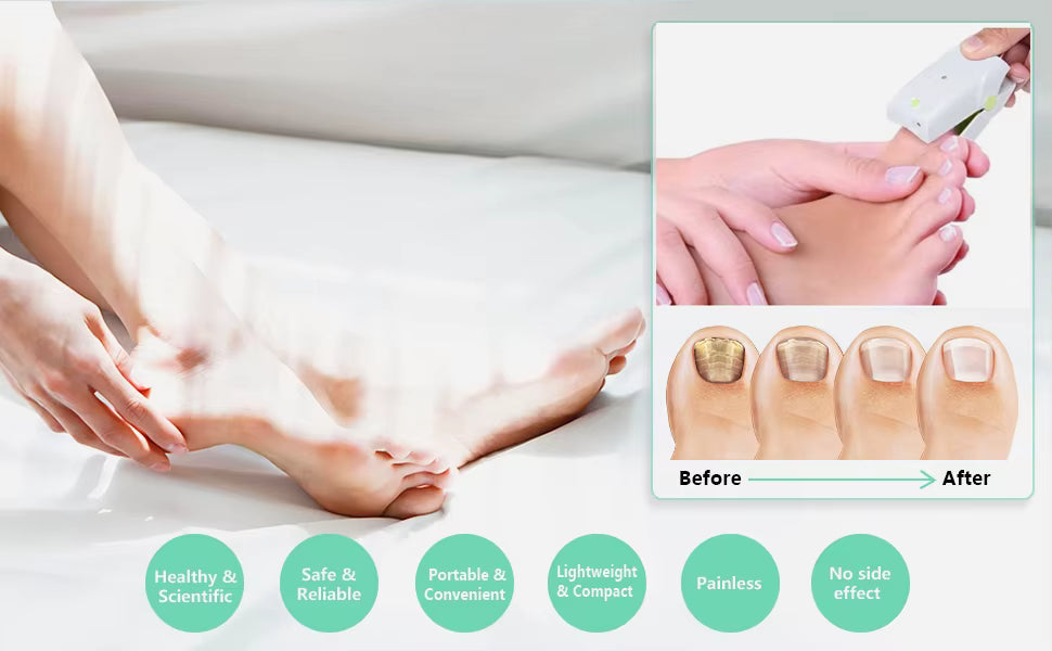 Fast Home Nail Fungus Laser Treatment Device