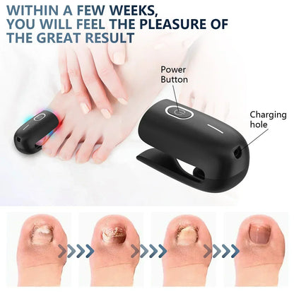 Compact Toenail Laser Treatment with USB Recharge