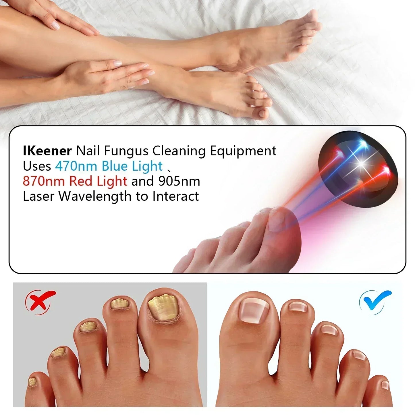Compact Toenail Laser Treatment with USB Recharge