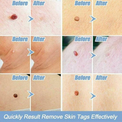 Skin Tag Removal Kit - Natural Painless Auto SKIN TAG Removal Skin tag bands Remover Device 3