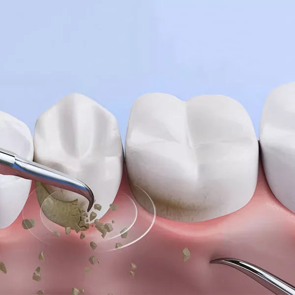 Effective Tartar Remover for Teeth