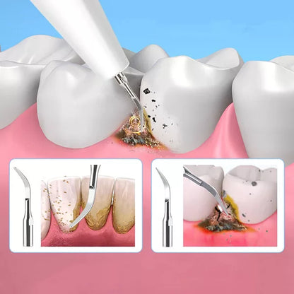 Effective Tartar Remover for Teeth