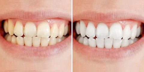 Fast At Home Teeth Whitening Kit