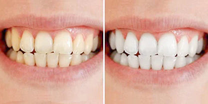 Fast At Home Teeth Whitening Kit