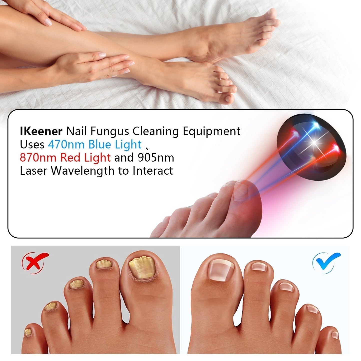 Fast Home Toenail Fungus Removal Laser Device
