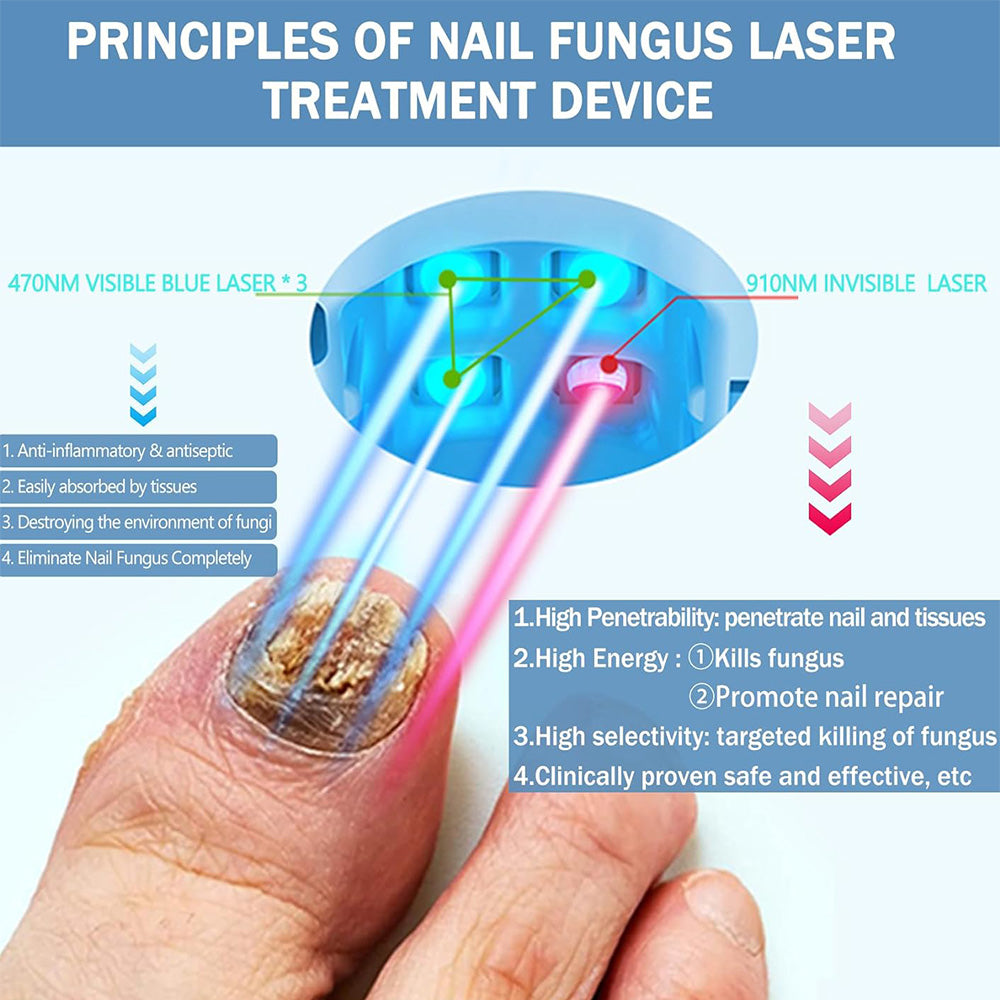 Easy Home Toenail Fungus Removal Laser Device