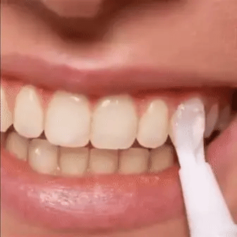 Fast At Home Teeth Whitening Kit