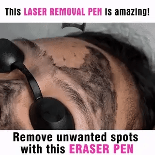 At Home Skin Tattoo Remover Laser Pen Device