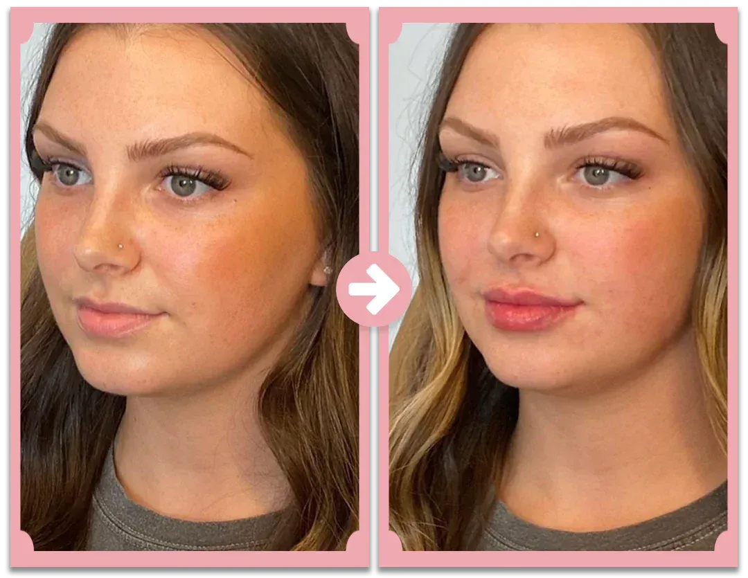 Natural Lip Enhancement Plumping Kit
