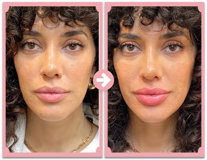 Natural Lip Enhancement Plumping Kit