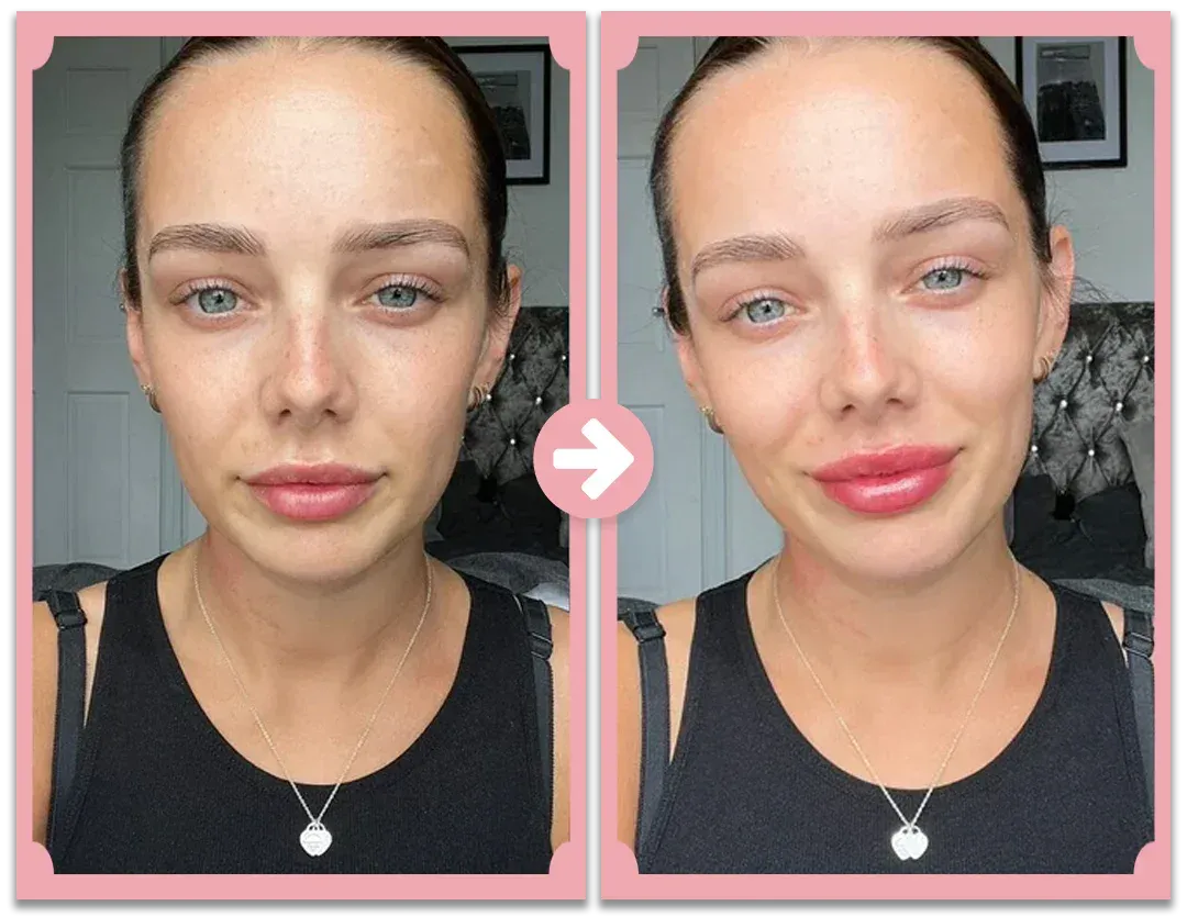 Natural Lip Enhancement Plumping Kit