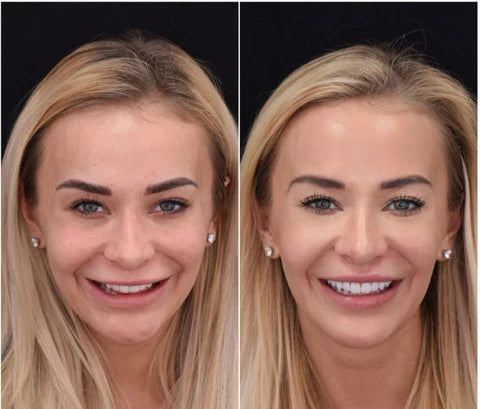 Easy Fit Smile Veneers for Top and Bottom Teeth