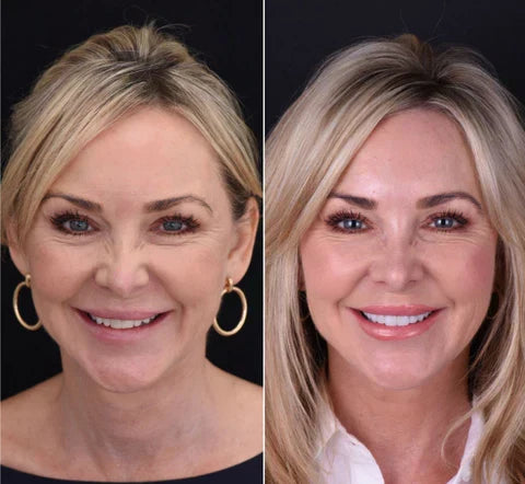 Easy Fit Clip On Veneers For A Perfect Smile