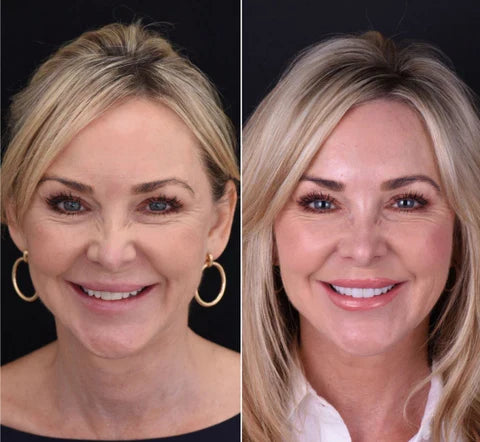 Easy Fit Smile Veneers for Top and Bottom Teeth