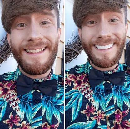 Easy Fit Smile Veneers for Top and Bottom Teeth