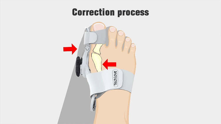 Comfortable Bunion Support for Foot Pain Relief